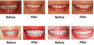 Dentistry under Cosmetic Dentistry